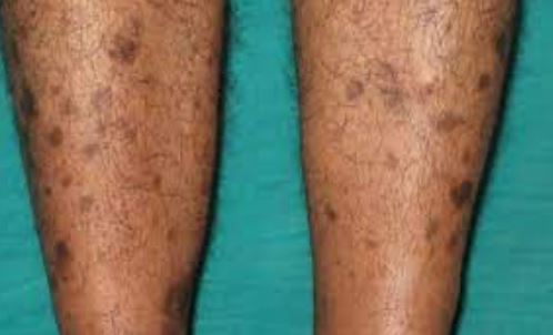 Dark Spots on Legs